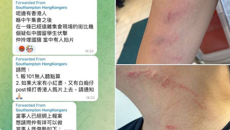 港人在参与集会后被疑似中国留学生殴打,手臂和颈部多处留有伤痕。(推特截图/Carmen Lau 劉珈汶@carmenkamanlau)